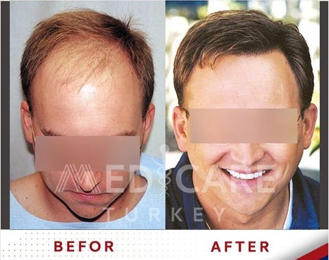 before after hair transplantation hair transplant قبل وبعد زراعة شعر