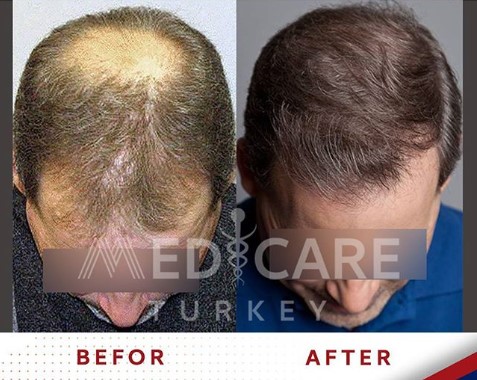 before after hair transplantation قبل وبعد زراعة شعر