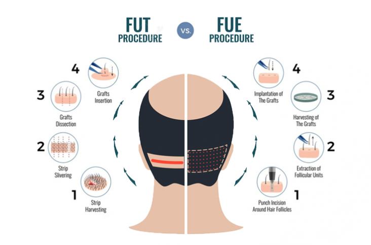 Hair Transplantation Techniques FUT VS FUE DHI Medicare Turkey Hair Transplantation Techniques FUT VS FUE DHI Medicare Turkey